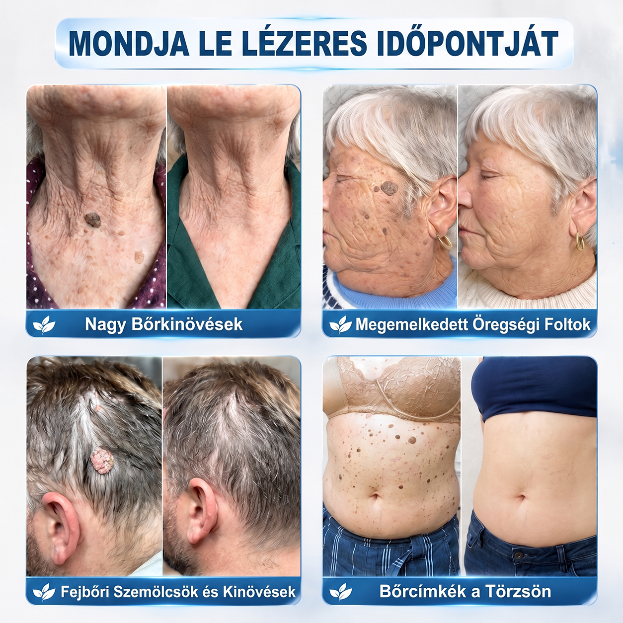 💕Hivatalos Márkabolt | 🚢🚢 Hiskin® 7 napos Szemölcseltávolító Roll-on Ápoló Folyadék (Fájdalommentes rollerball technológia, hegek nélkül) 🐬