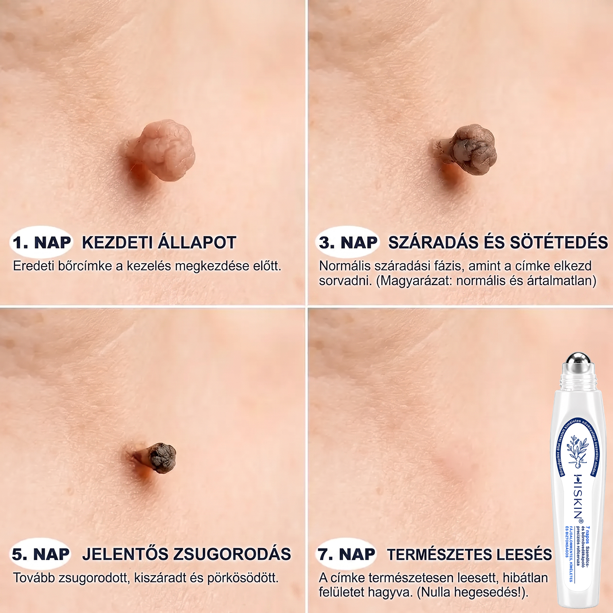 💕Hivatalos Márkabolt | 🚢🚢 Hiskin® 7 napos Szemölcseltávolító Roll-on Ápoló Folyadék (Fájdalommentes rollerball technológia, hegek nélkül) 🐬